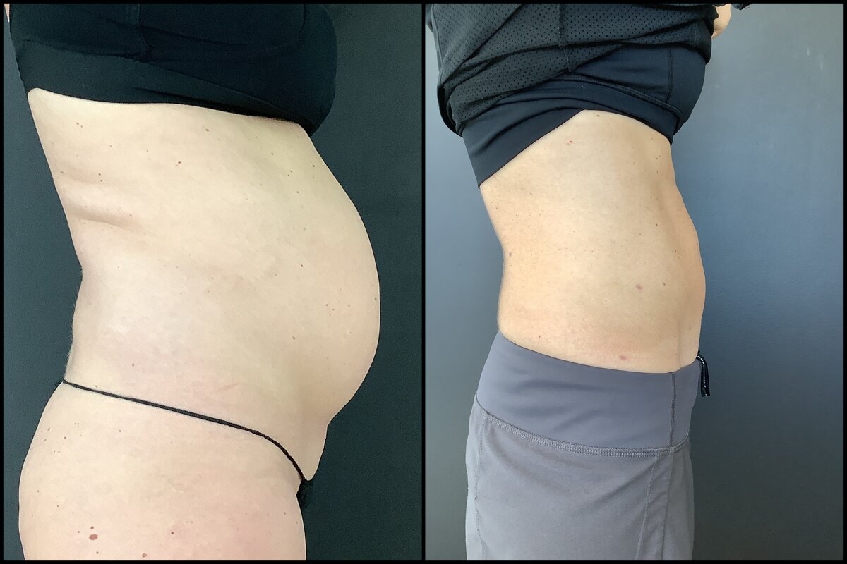 Laser Liposuction - Abdomen (Side View) Before and After