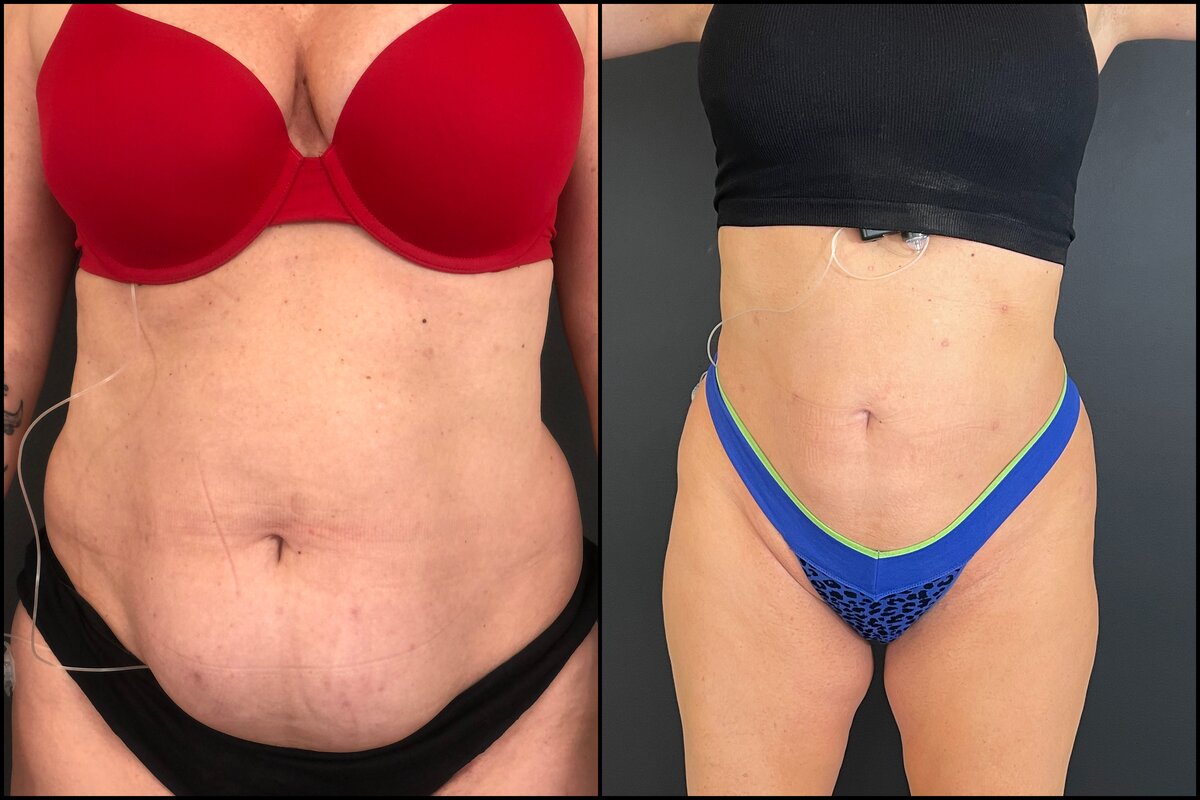 Laser Liposuction - Abdomen (Front View) Before and After