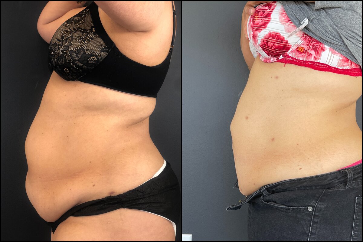 Laser Liposuction - Abdomen (Lateral View) Before and After