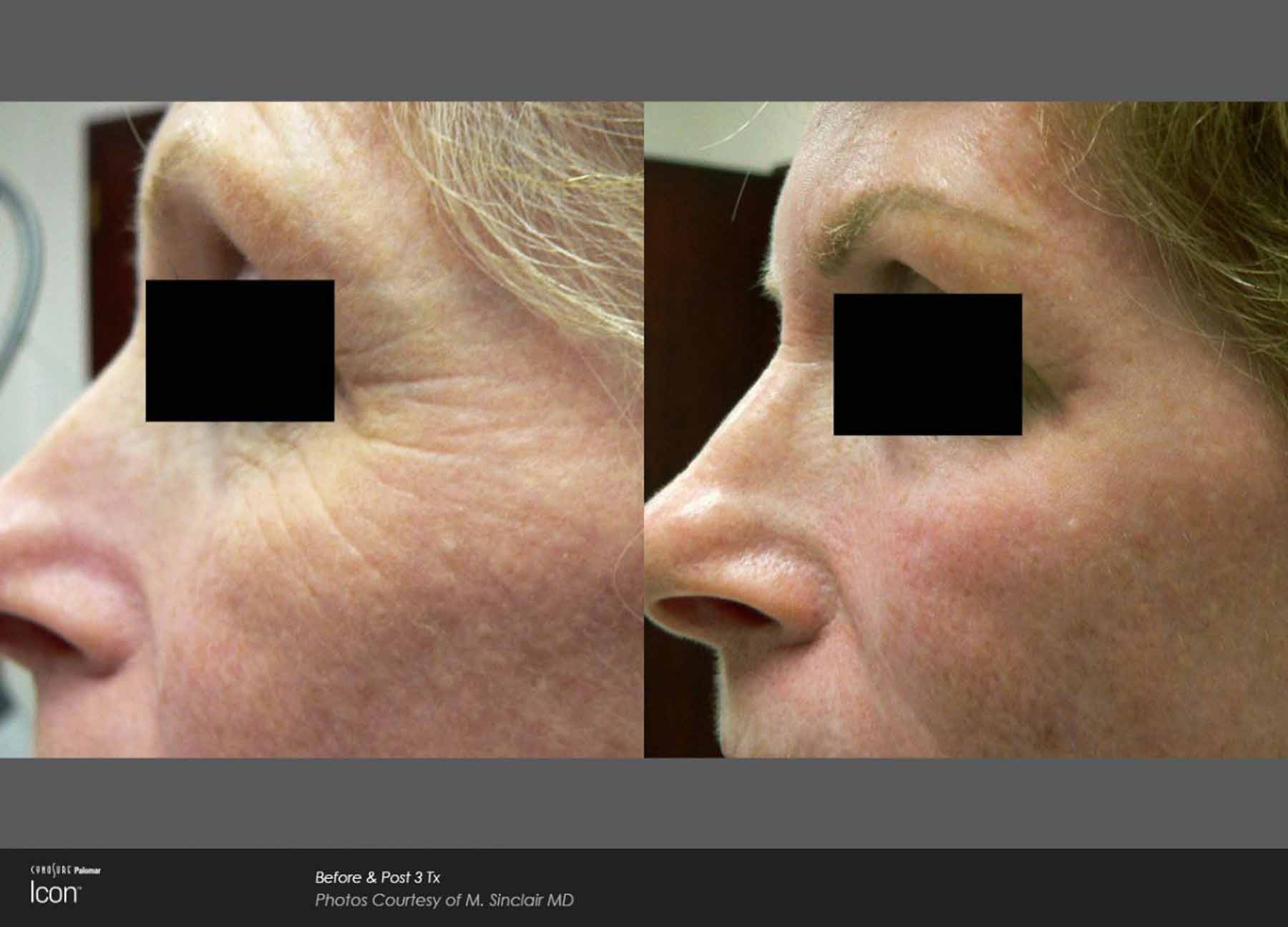 Wrinkle and fine line removal treatments Lindon Medical Lasers