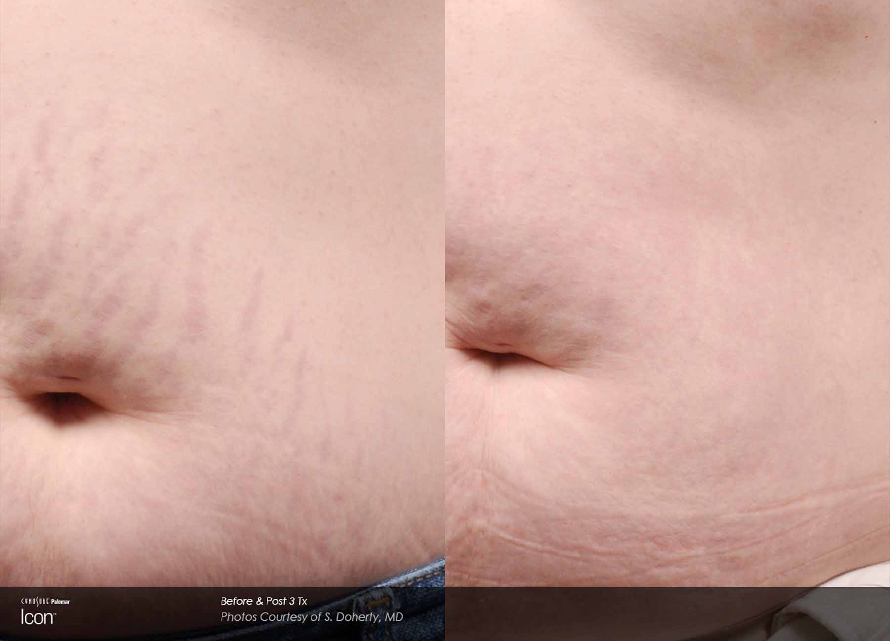 Stretch Mark Removal Treatments Lindon UT