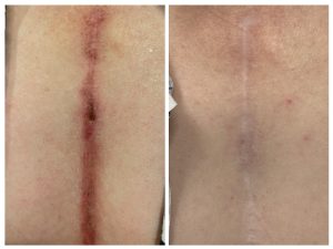 Renova Scar Revision before and after