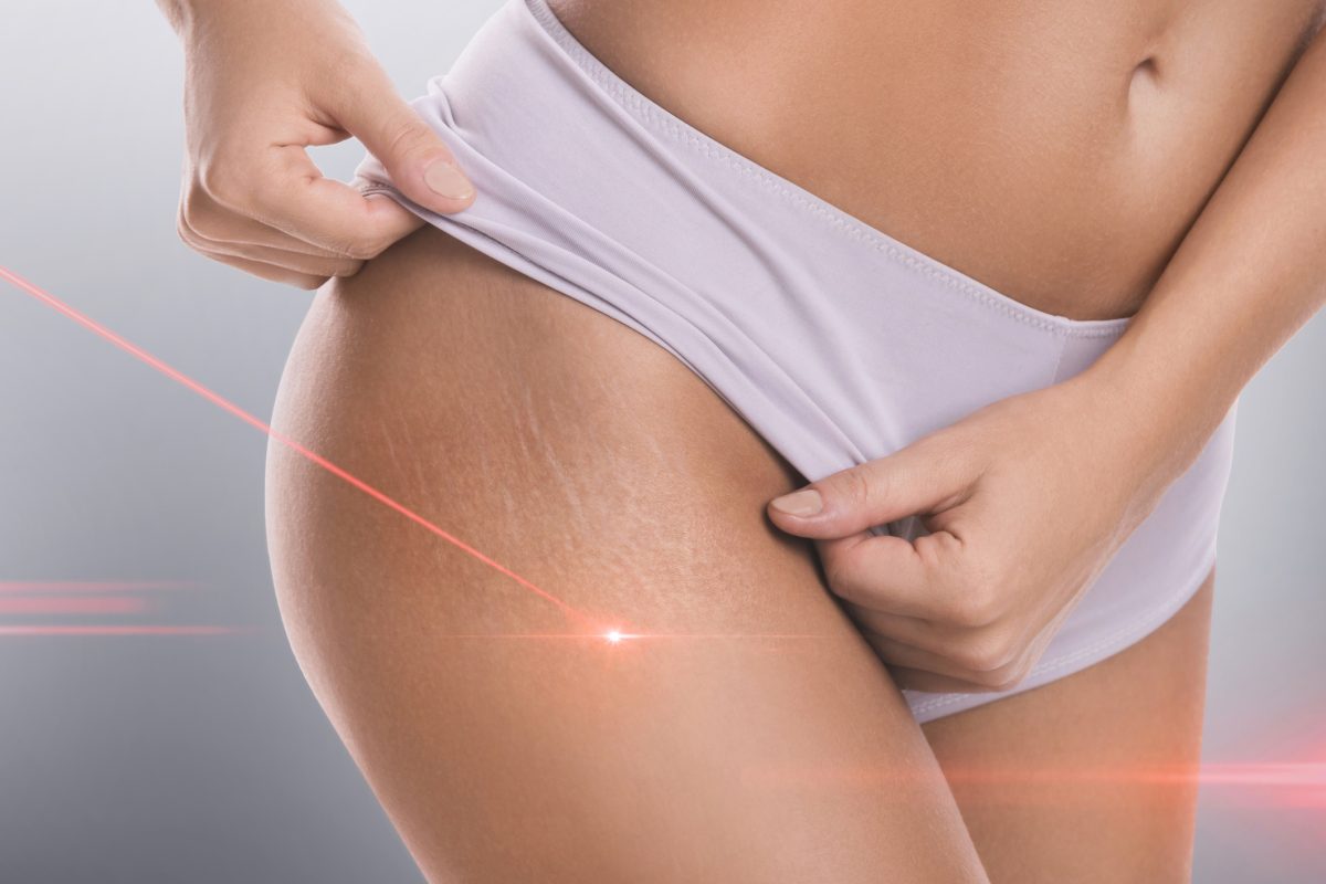 Laser being used on skin for anti-aging